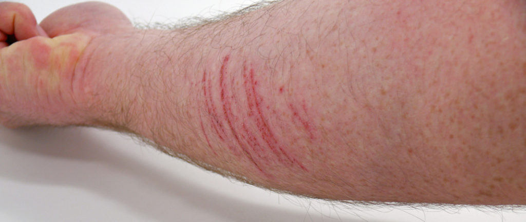 Autolesionismo Fotolia 80103960 S 1024x432